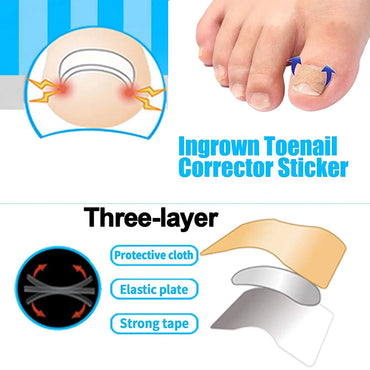 Ingrown Toenail Tools Set Ingrown Toenail Correction Patch Stickers Corrector Pedicure Tool Ingrown Toe Nail Treatment Foot Care