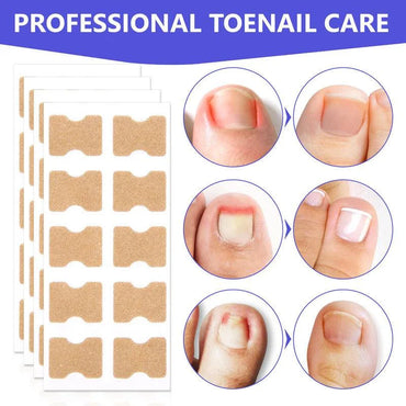 100pcs Nail Correction Patch Embedded in Toenail Correction Patches Repair Toes Orthodontic Paronychia Recover Pedicure Tool